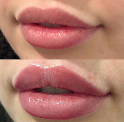 Russian Lips Juvederm Ultra 3 With Lidocaine Cross Linked Dermal Filler